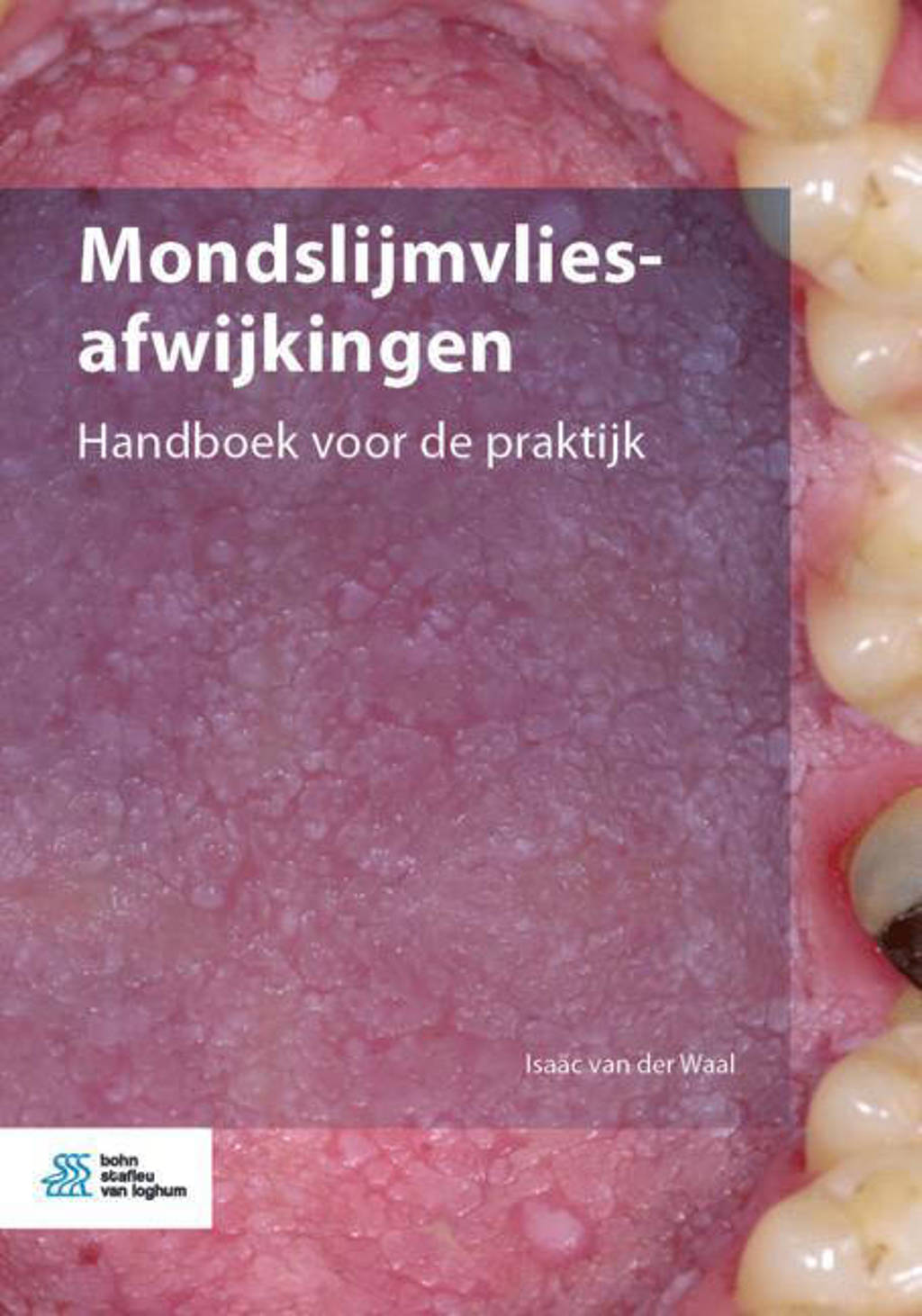 Mondslijmvliesafwijkingen - Isaäc van der Waal